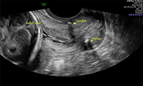 Rescue cerclage success: Advanced cervical dilatation with bulging bag ...