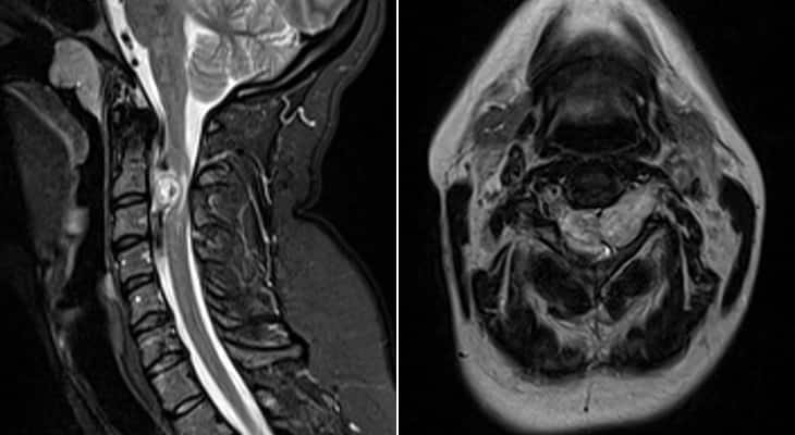 spinal-tumor-case-study-mass-blocked-90-of-canal-norton-healthcare