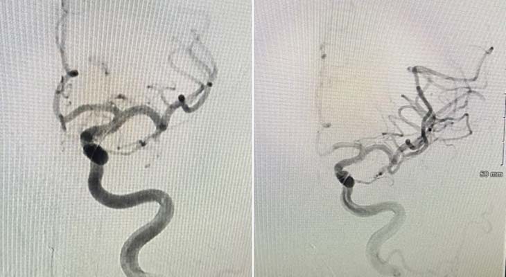 middle cerebral artery angiogram