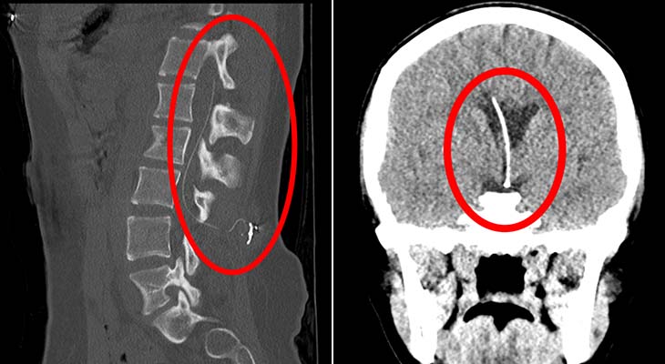 Medical images show a conventional baclofen pump placement and the cerebral catheter placement for this patient.