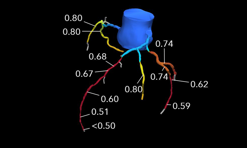 The CT-FFR HeartFlow analysis shows the locations and significance of cardiac blockages.