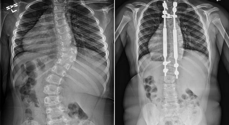 Magnetic Growing Rods For Scoliosis Norton Healthcare Provider Louisville Ky