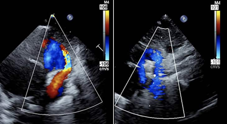 Pediatric heart case study Piccolo device closes PDA in 26 weeks