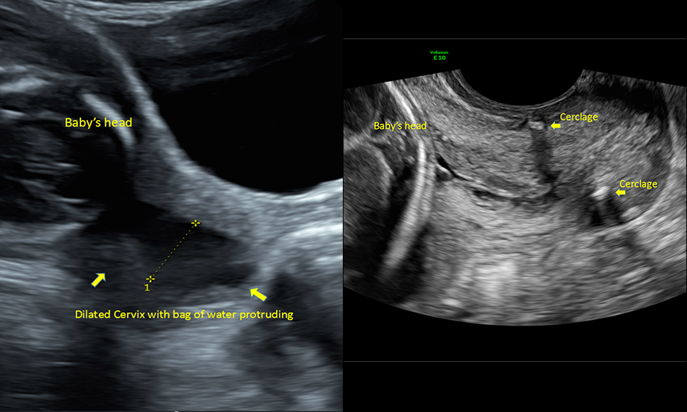 Rescue cerclage success Advanced cervical dilatation with bulging