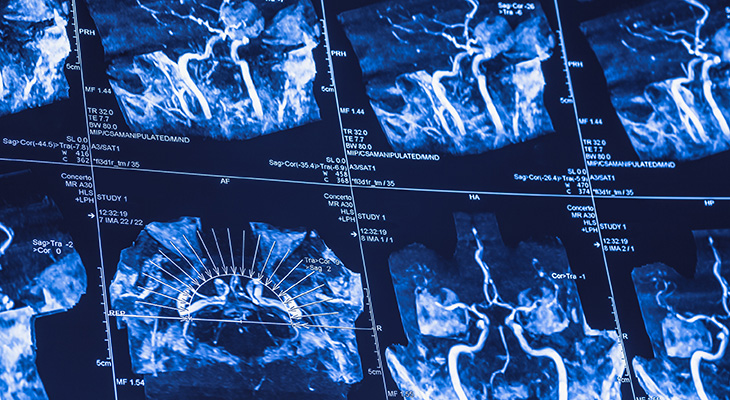 MRI brain images are shown, illustrating tPA window