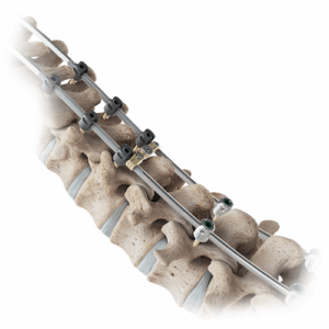 A closeup of the VerteGlide Spinal Growth Guidance System